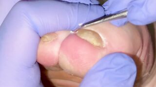 Gross Soles Pedicure ASMR