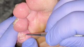 Gross Soles Pedicure ASMR