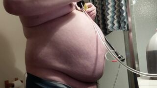 Abdomen Inflation with Nearly two Gallons of Water