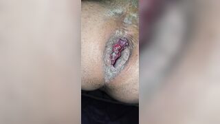 Enorme prolapso anal invasion